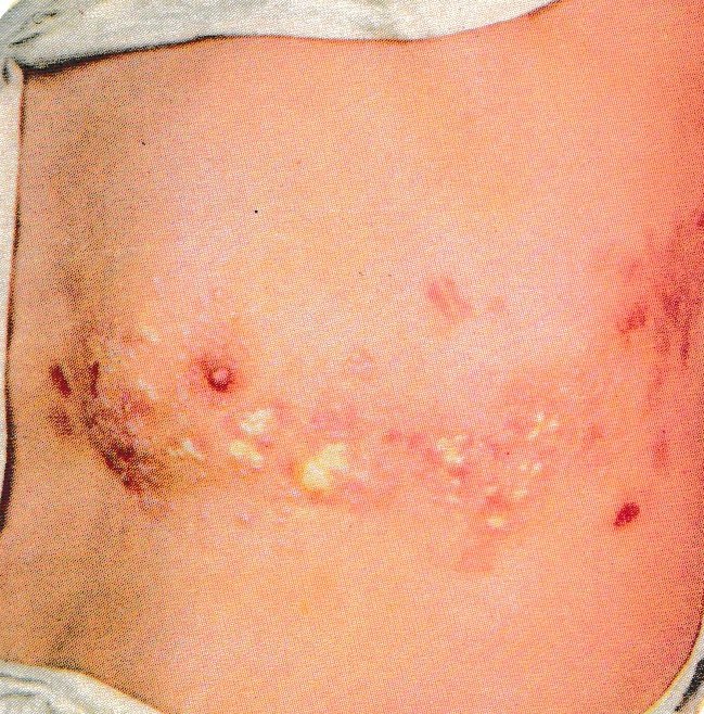 ZONA des séquelles douloureuses qui peuvent durée parfois des années