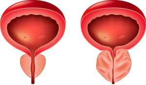 Magnétiseur guérisseur pour les soucis de prostate et la prostatite. Le saw palmetto est l'une des plantes étudiées pour la santé de la prostate.